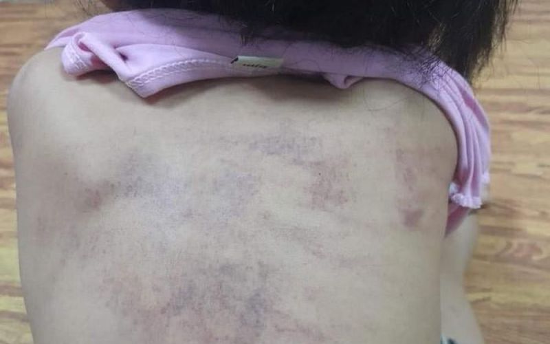 Hải Phòng: Xác minh sự việc bé 5 tuổi bị bầm tím ở vùng lưng chưa xác định được nguyên nhân